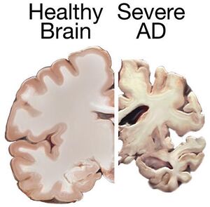 Alzheimers brain.jpg